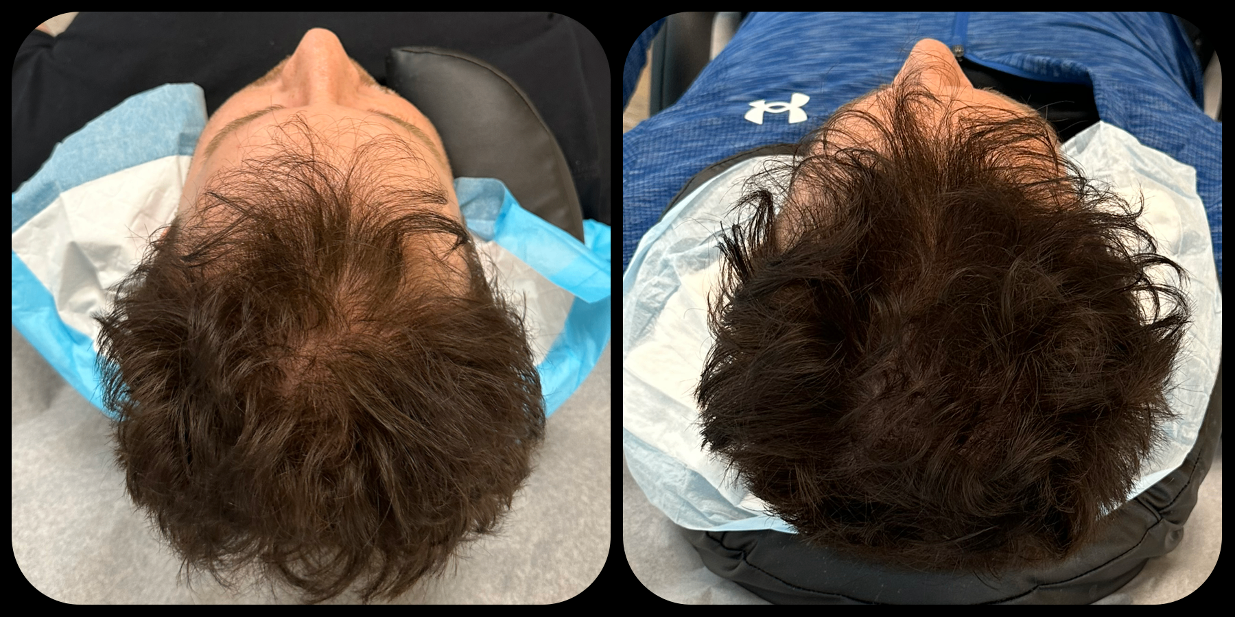 Male patient crown top-down before and after hair restoration — significant density improvement