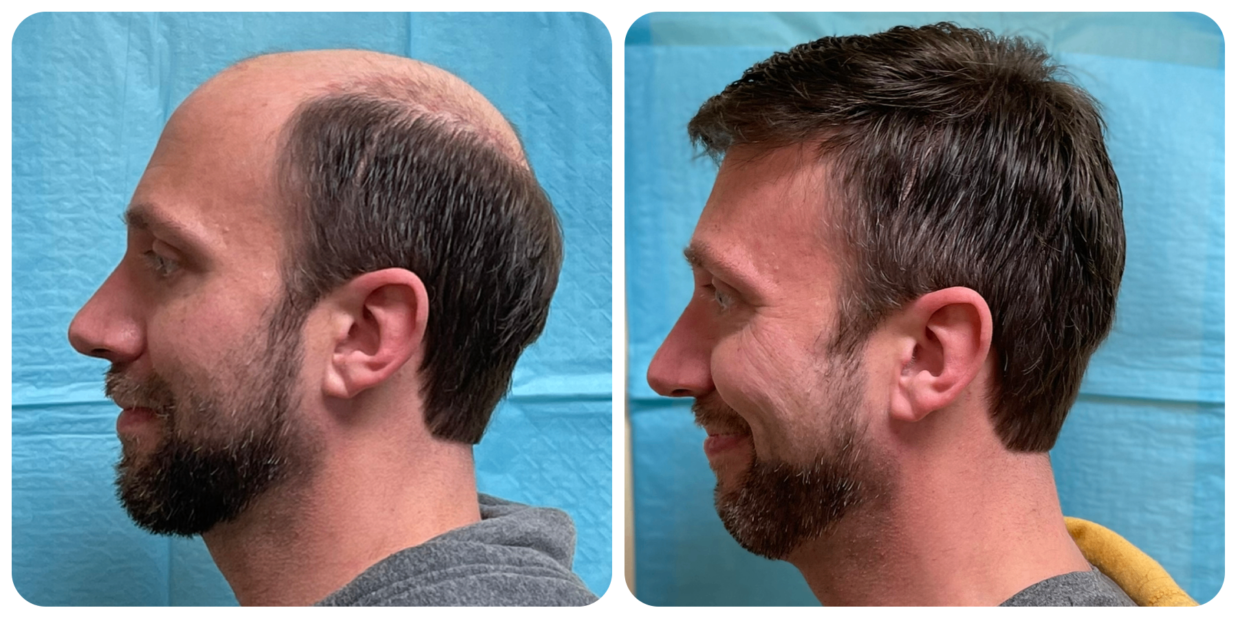Male patient side profile before and after hair restoration — full coverage and natural hairline