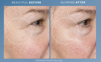 HydraFacial before and after results — smoother, glowing skin around the eye area