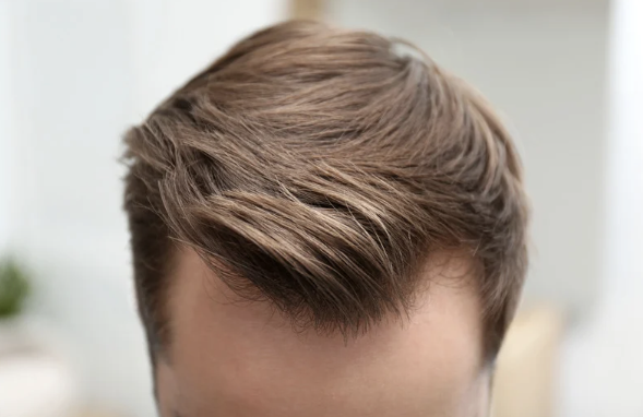 Non-Surgical Hair Systems: Modern, Custom Hair Replacement That Looks Real