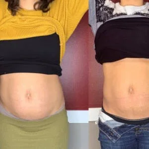 Body contouring before and after — stomach slimming at Remedy+