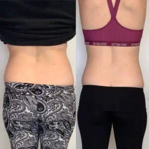 Body contouring before and after — back and waistline at Remedy+