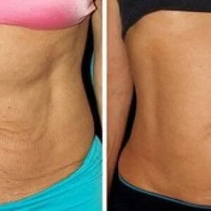 Skin tightening before and after — flank area at Remedy+