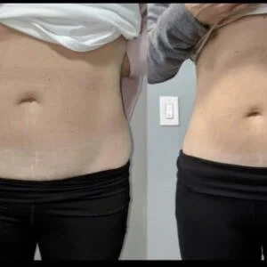 Body contouring before and after — abdomen tightening at Remedy+