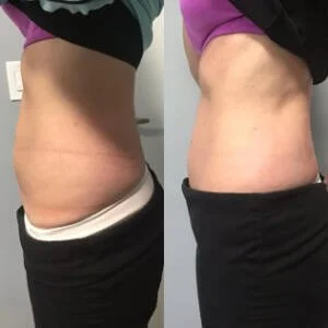 Body contouring before and after — side profile at Remedy+
