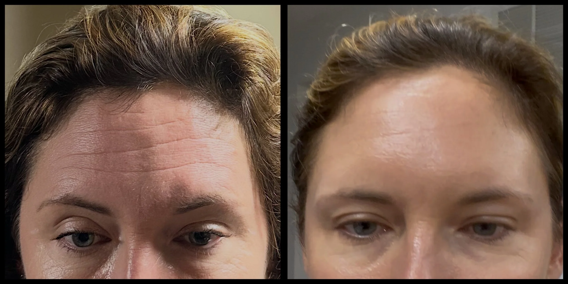 BOTOX® before and after — forehead lines softened at Remedy+