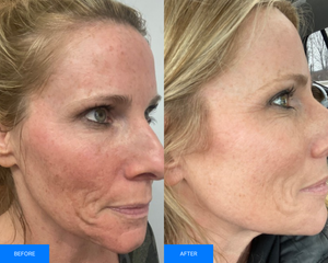 Before and after VI Peel treatment at Remedy+ showing clearer, more radiant skin