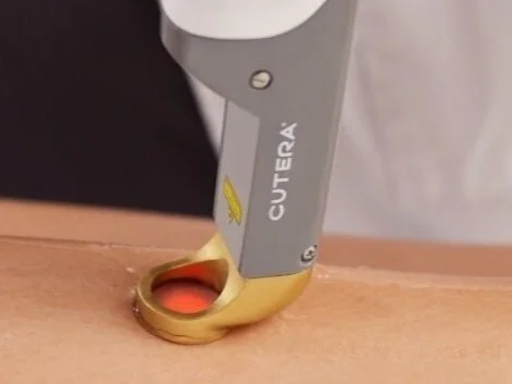 CUTERA CoolGlide laser hair removal treatment