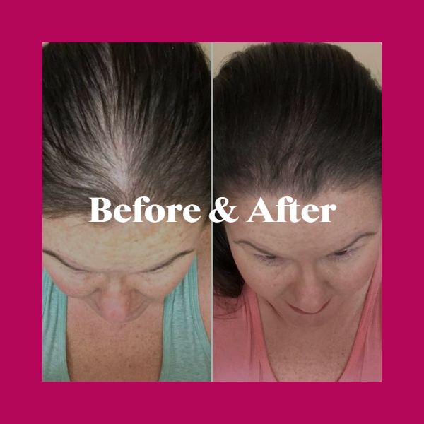 Female hairline restoration before and after — increased density at the part and crown