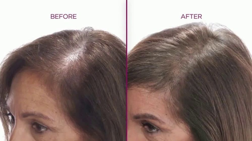 Female crown hair restoration before and after — increased density and coverage at the part