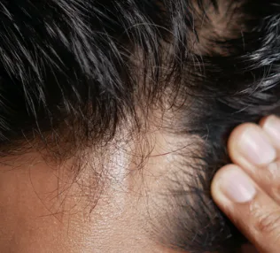 Hair Restoration treatment at Remedy+ Grand Rapids MI