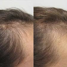 Male hairline restoration before and after — denser, fuller hairline