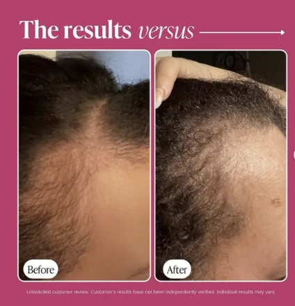 Male hair restoration results — before and after showing regrowth and increased density