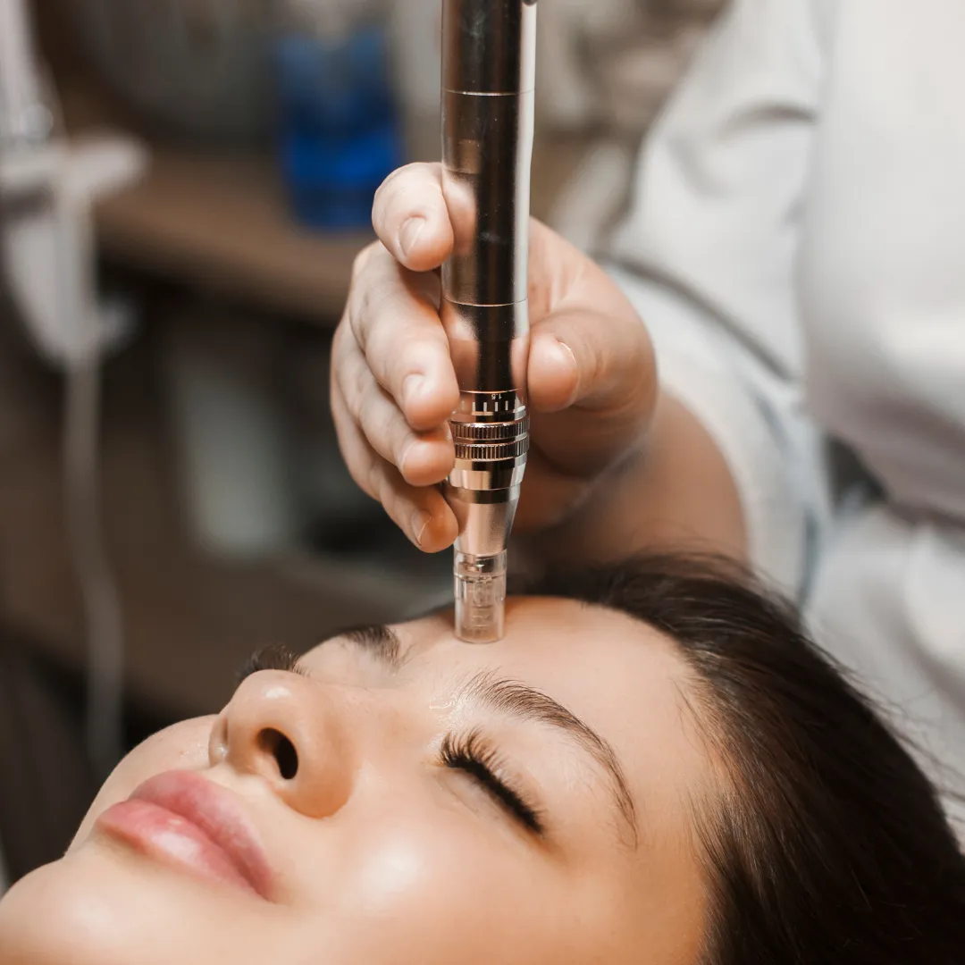 Microneedling treatment at Remedy+ Grand Rapids MI