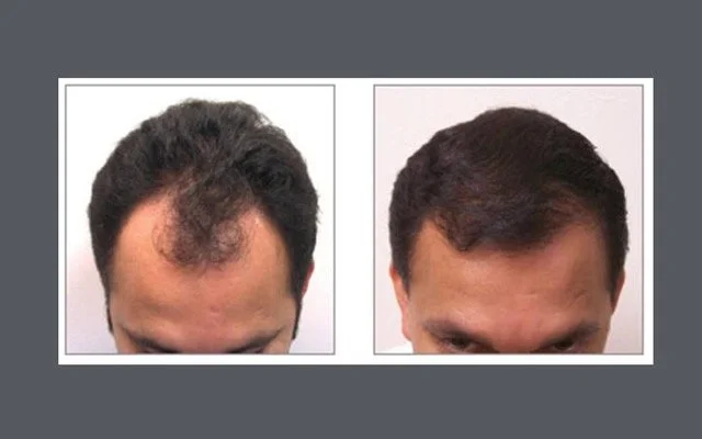 Hair restoration before and after results at Remedy+
