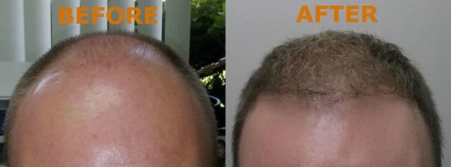 NeoGraft before and after showing significant hair regrowth