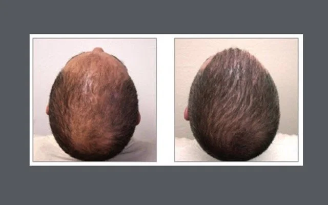 Hair transplant before and after crown restoration results
