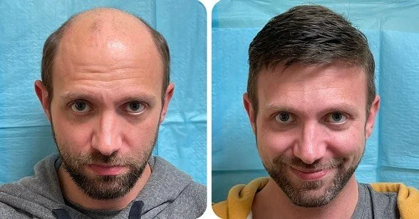 FUE hair transplant dramatic before and after transformation