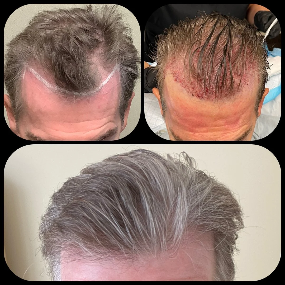 SmartGraft hair restoration before during and after results