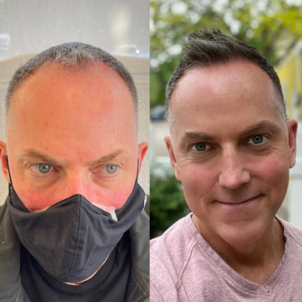 Hair restoration before and after showing full coverage results