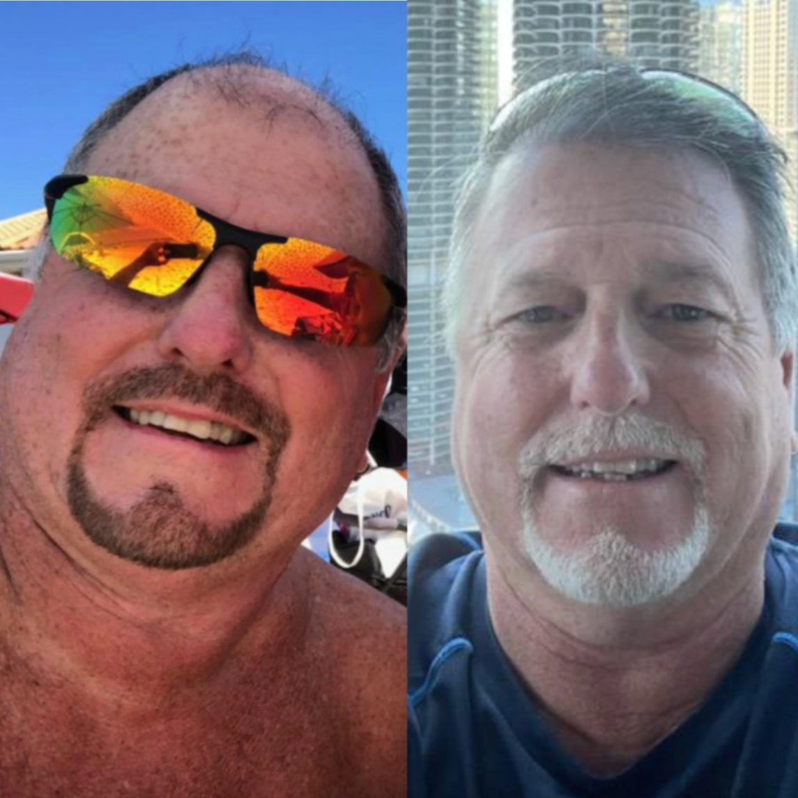 Hair transplant before and after showing natural-looking results