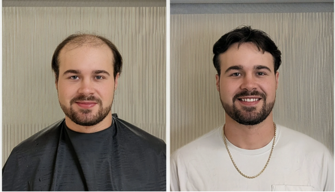 Learn More About Hair Systems
