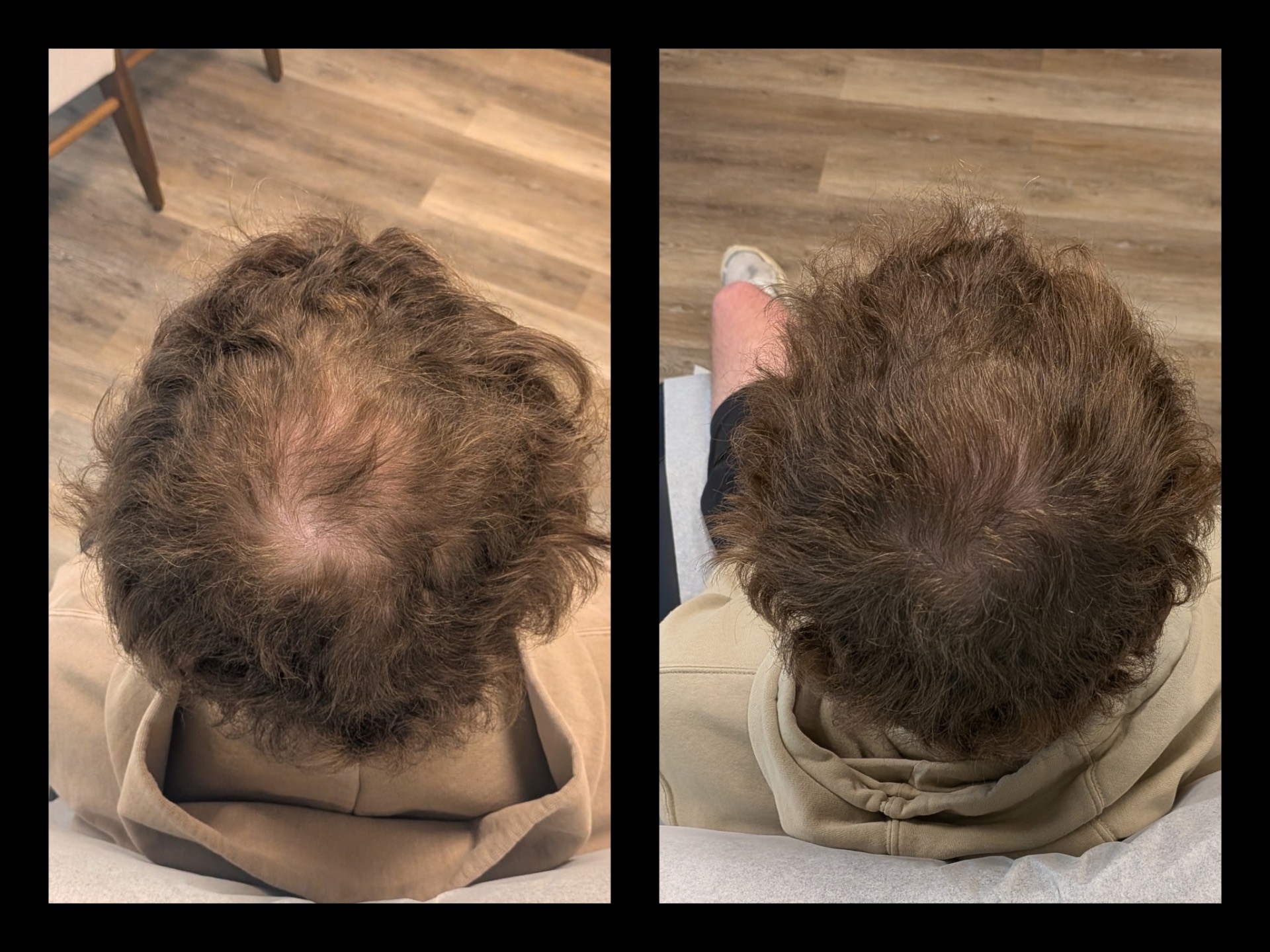 Patient crown hair restoration before and after — significant density improvement and full coverage