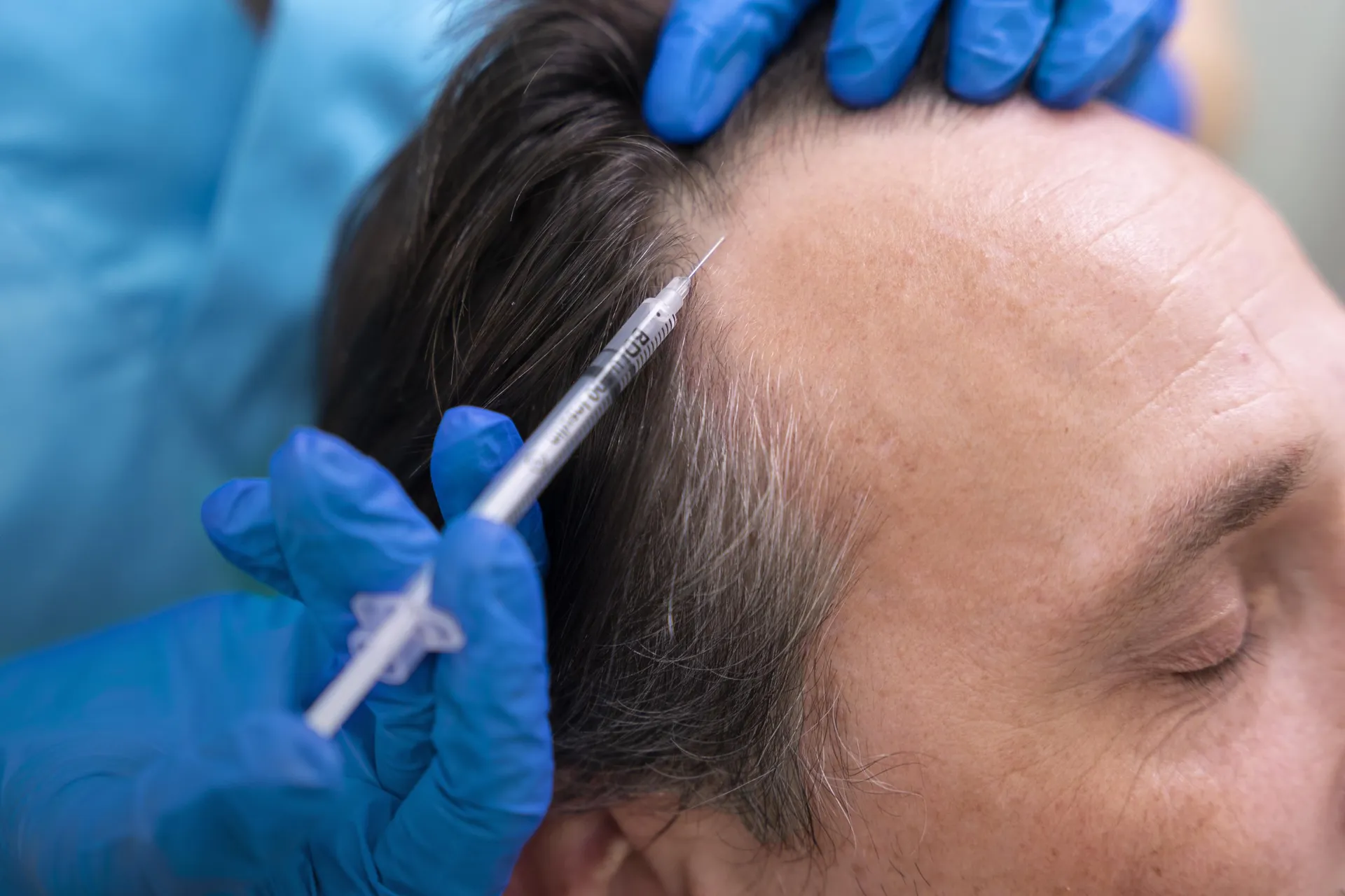 PRP Hair Restoration treatment at Remedy+ Grand Rapids MI