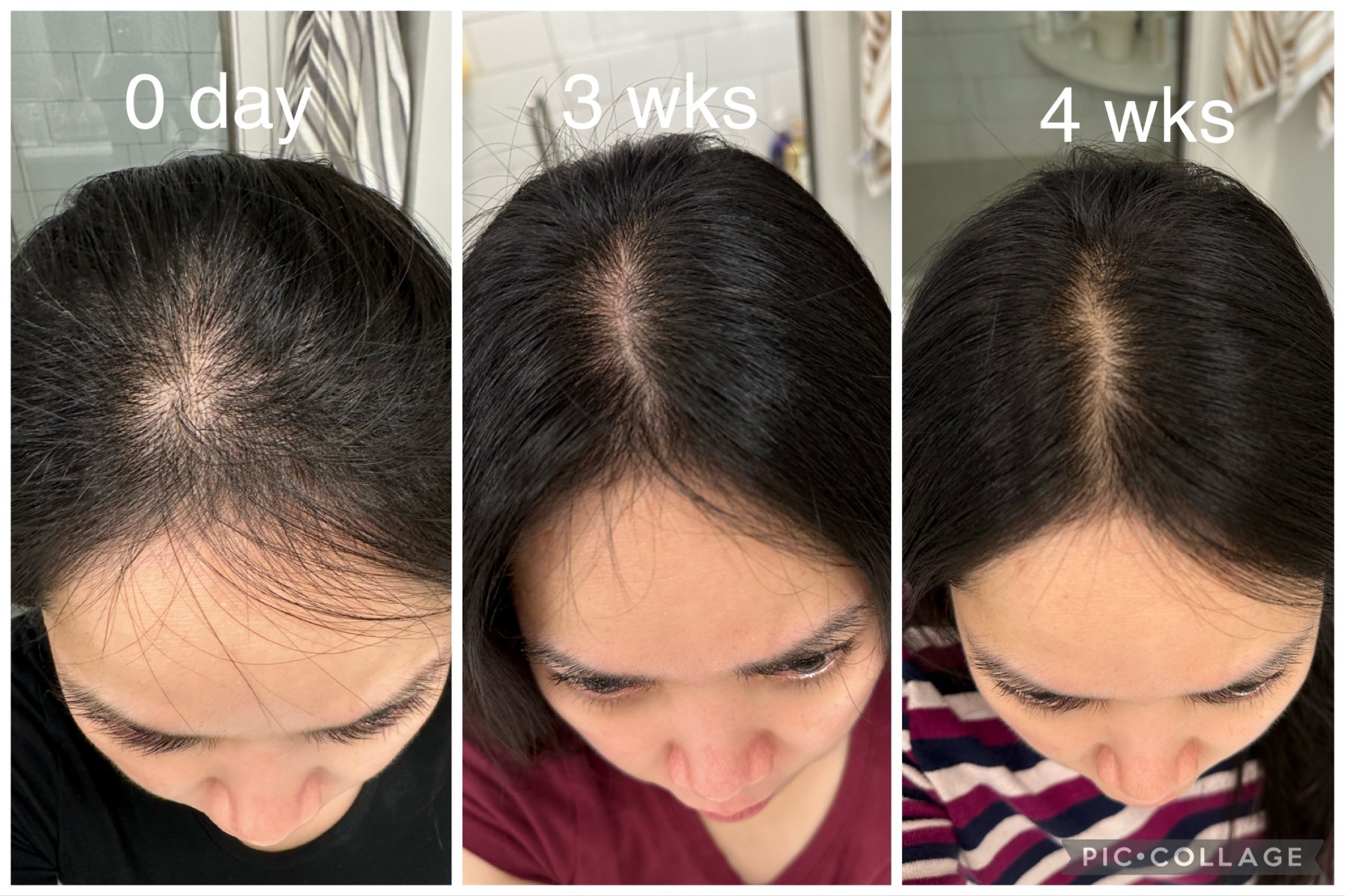Female hair restoration progression — day 0, 3 weeks, and 4 weeks showing density improvement at the part